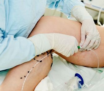 Foto minimalinvasive Venentherapie